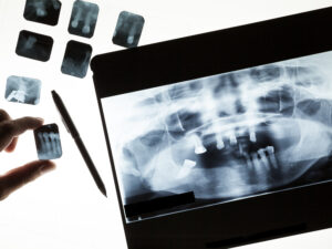 Dental,Xray,With,Dentist,Hand
